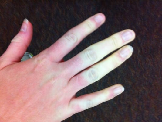 Tay bệnh nhân bị mắc hội chứng Raynaud