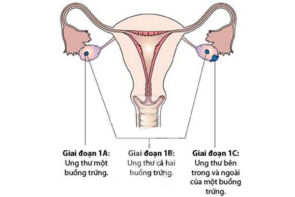 ung thư buồng trứng giai đoạn 1