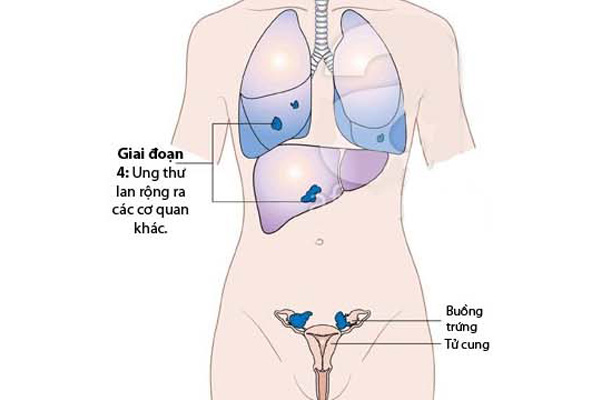 ung thư buồng trứng giai đoạn 4