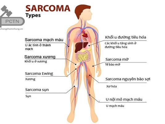 Các typ Sarcoma