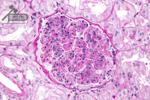 Tế bào thận sau khi bị nhiễm trùng