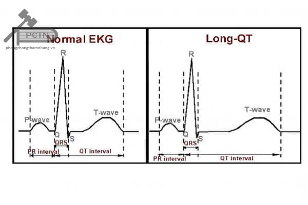 Điện tâm đồ có QT bình thường với điện tâm đồ có QT kéo dài