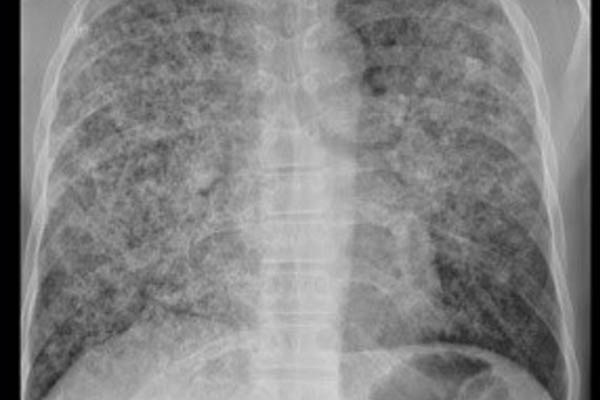X-quang phổi ở bệnh nhân nhiễm P.carinii
