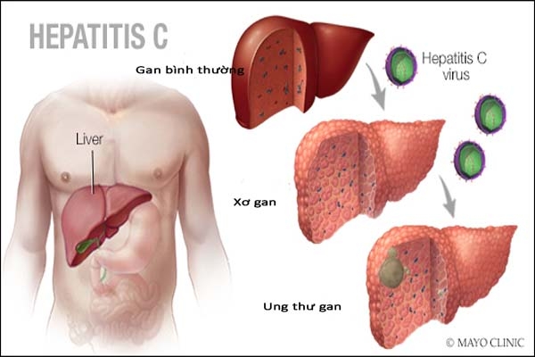 Các giai đoạn phát triển của bệnh viêm gan C