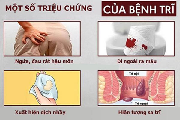 Một số triệu chứng của bệnh trĩ