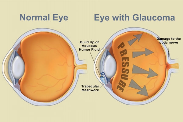 Chống chỉ định sử dụng Chlorpheniramine với bệnh nhân tăng nhãn áp (glaucoma)