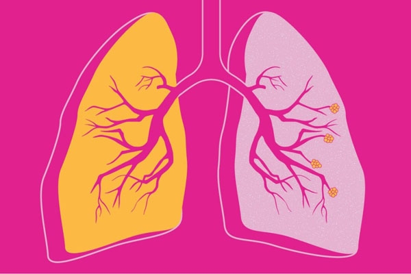 Chống chỉ định sử dụng Berodual ở bệnh nhân phổi tắc nghẽn mạn tính (COPD)