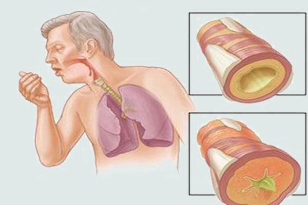 Dimedrol điều trị dị ứng đường hô hấp