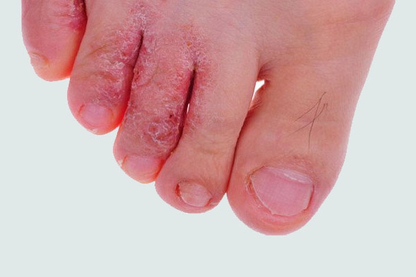 Griseofulvin 500mg dùng trong điều trị các bệnh nhân bị nấm bàn chân