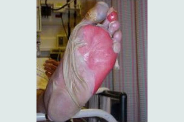 Loét ngón chân cái (nhiễm trùng khởi đầu) trong TEN