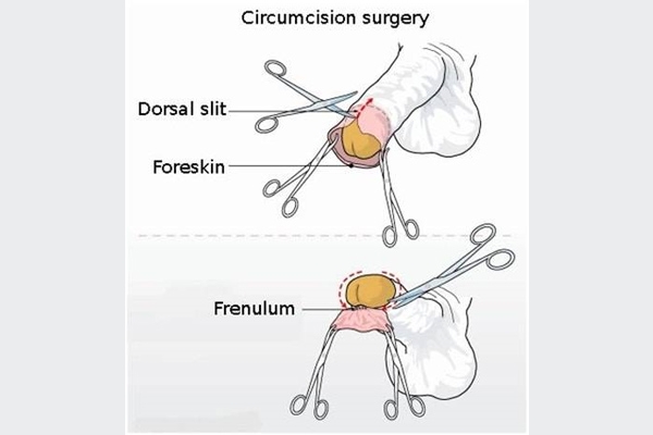 Mô tả quá trình tiểu phẫu cắt bao quy đầu.