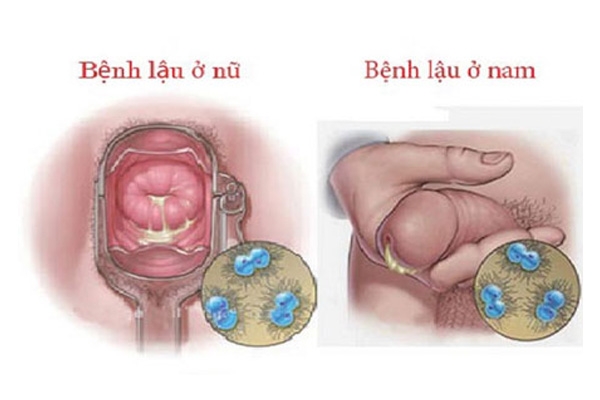 Triệu chứng lâm sàng bệnh lậu ở nam giới và nữ giới