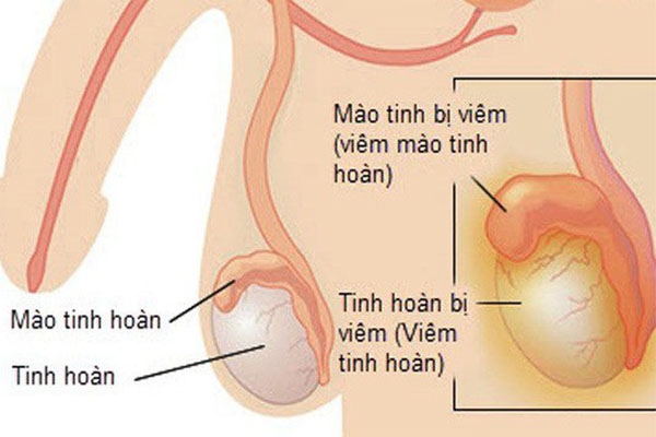 Viêm mào tinh hoàn