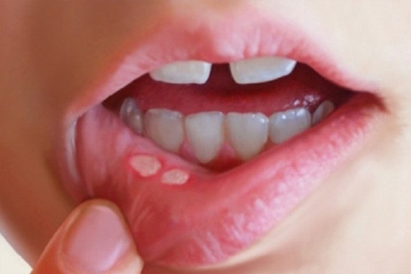Oral Sex có thể gây ra 1 số bệnh răng miệng