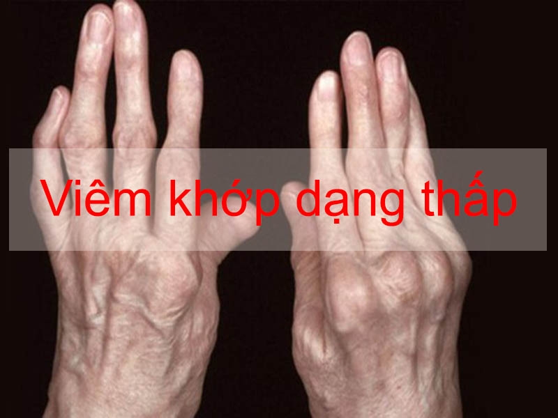 Bệnh viêm khớp dạng thấp