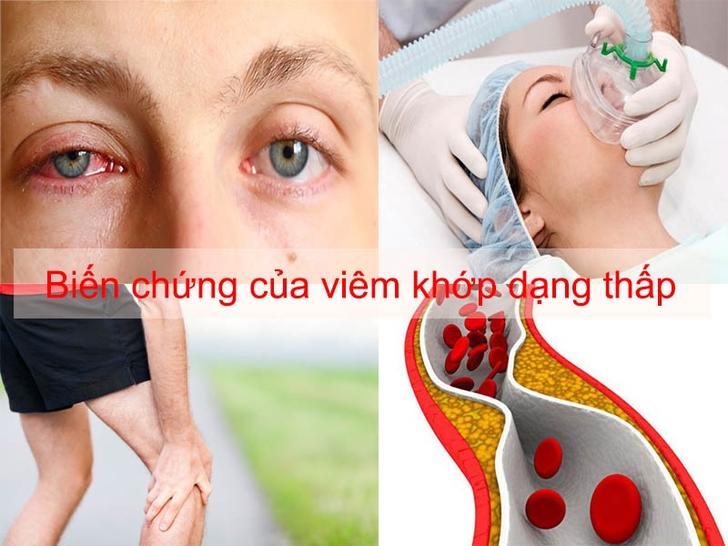 Biến chứng của bệnh viêm khớp dạng thấp