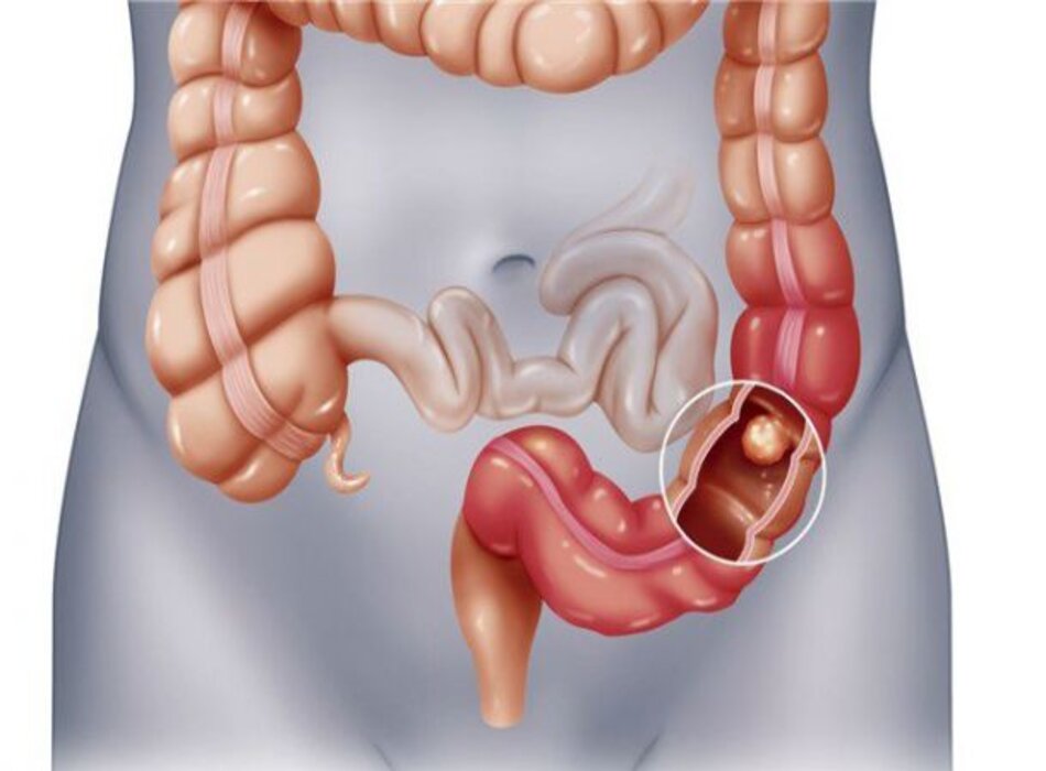 Điều trị ung thư đại trực tràng theo giai đoạn