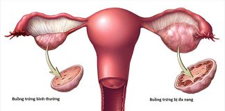 Chẩn đoán hội chứng buồng trứng đa nang