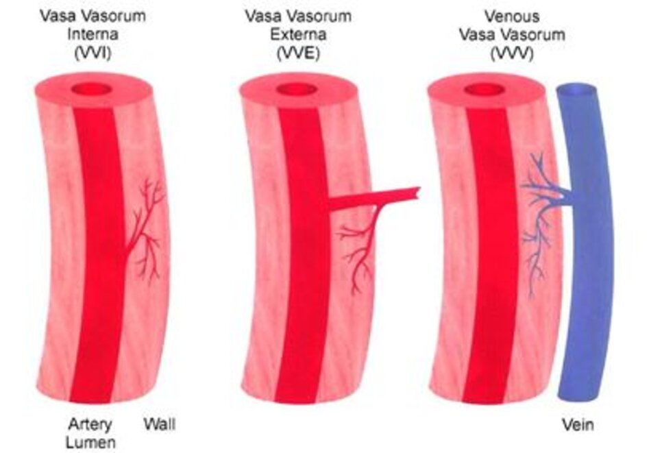 Hình 6: Tổn thương cột sau và rễ thần kinh sau tủy sống trong Tabes dorsalis