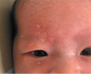Ca lâm sàng: Bé gái 3 tuần tuổi, đến khám với tình trạng nổi mụn nước, nghẹt mũi nhẹ và quấy khóc