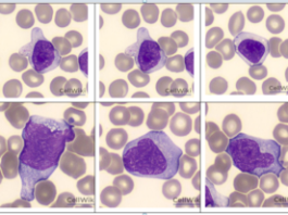 Ca lâm sàng: Bệnh tăng Lymphocyte không điển hình (Kissing Disease)