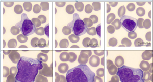 Ca lâm sàng: Bệnh tăng Lymphocyte không điển hình (Kissing Disease)