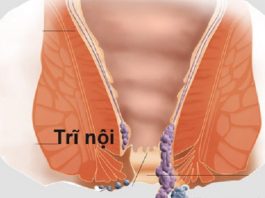 Trĩ nội và trĩ ngoại