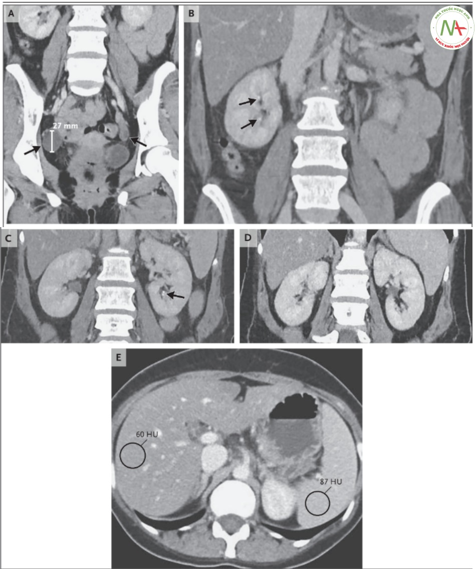 Hình 2. CT scan ổ bụng và vùng chậu