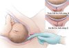 Thời điểm khởi phát chuyển dạ tối ưu sau ối vỡ non ở thai đủ thángThời điểm khởi phát chuyển dạ tối ưu sau ối vỡ non ở thai đủ tháng