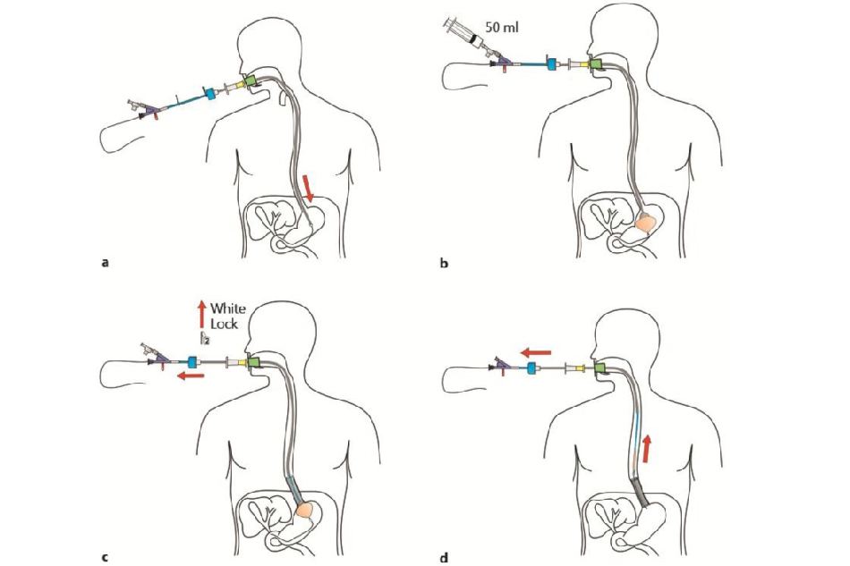 Đặt Stent Danis thực quản