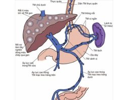 QUẢN LÝ CHẢY MÁU DO VỠ GIÃN TĨNH MẠCH DẠ DÀY THỰC QUẢN