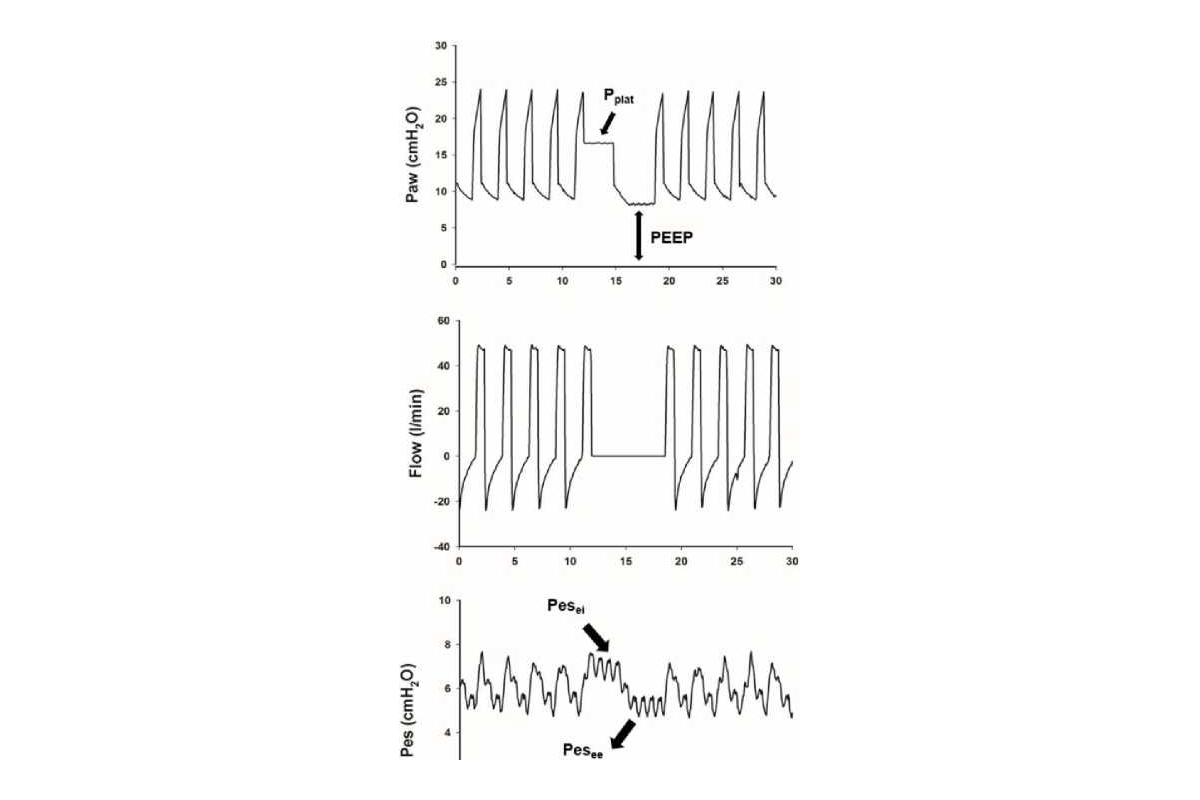 Hình 5. Áp lực đẩy xuyên phổi như một thước đo nhạy cảm hơn về mức độ stress phổi. Các dạng sóng áp lực đường thở (Paw), lưu lượng, áp lực thực quản (Pes) và áp lực xuyên phổi (Pl) được ghi lại từ một bệnh nhân khi thở máy kiểm soát thể tích (Vt 500 - 7,1 ml/kg IBW, nhịp thở 20, PEEP 8 cm H2O) với ARDS vừa phải. Sự khác biệt giữa Paw và Pes là Pl. Vì Pplat là 17 cm H2O và Pes cuối thì hít vào (Pes-ei) là 7 cm H2O, kết quả PL-ei là 10 cm H2O, trong khi PEEP 8 cm H2O trừ P es cuối thì thở ra (Pes-ee) là 3 cm H2O kết quả PL-ee là 5 cm H2O. Do đó, việc áp lực đẩy xuyên phổi (APl = 5 cm H2O) ở bệnh nhân này nằm trong giới hạn an toàn (tức là 8-10 cm H2O) Mauri và cộng sự (2016).