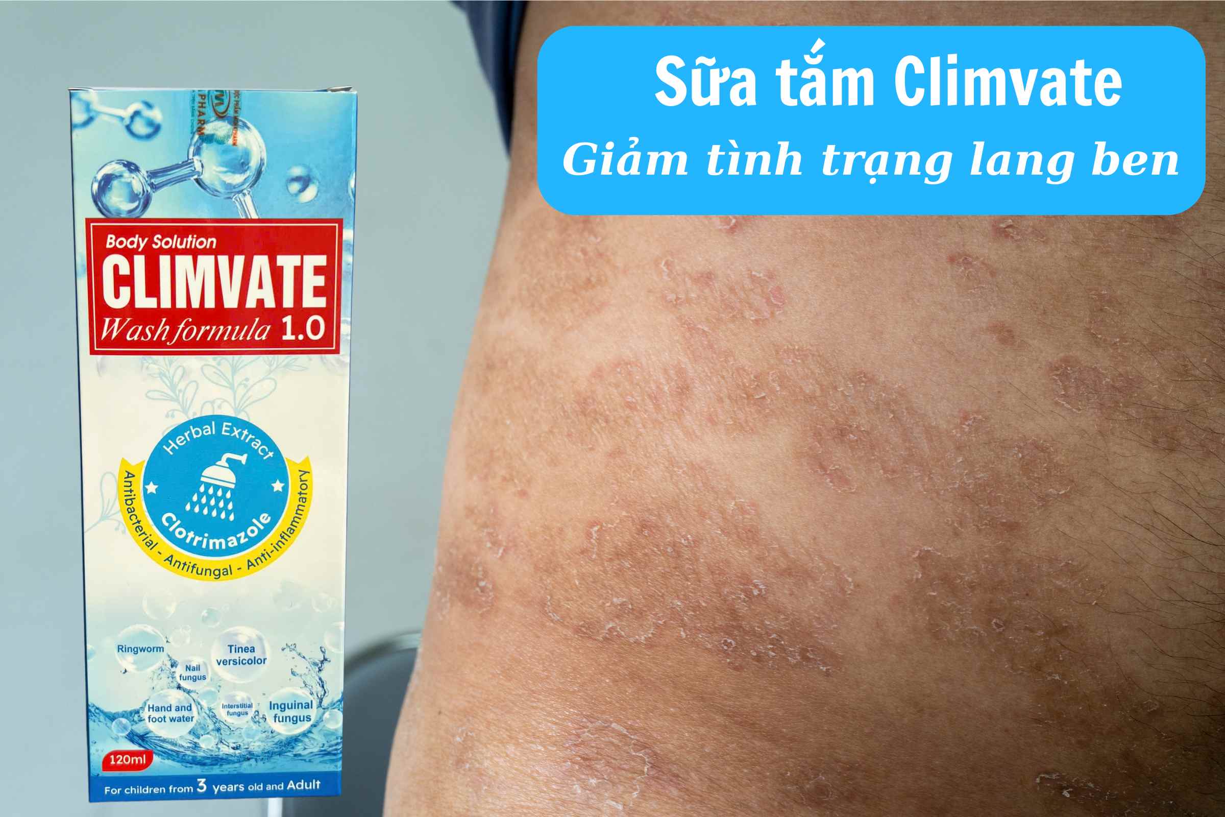 Sữa tắm Climvate hỗ trợ giảm lang ben