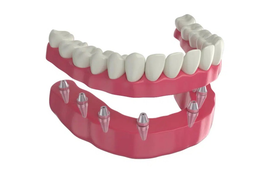 Công nghệ cấy ghép Implant 